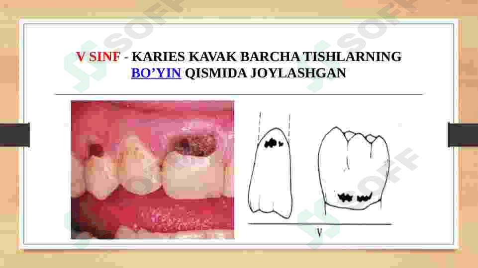 BLEK BO'YICHA V-VI KARIES KOVAKLARINI CHARXLASH 3