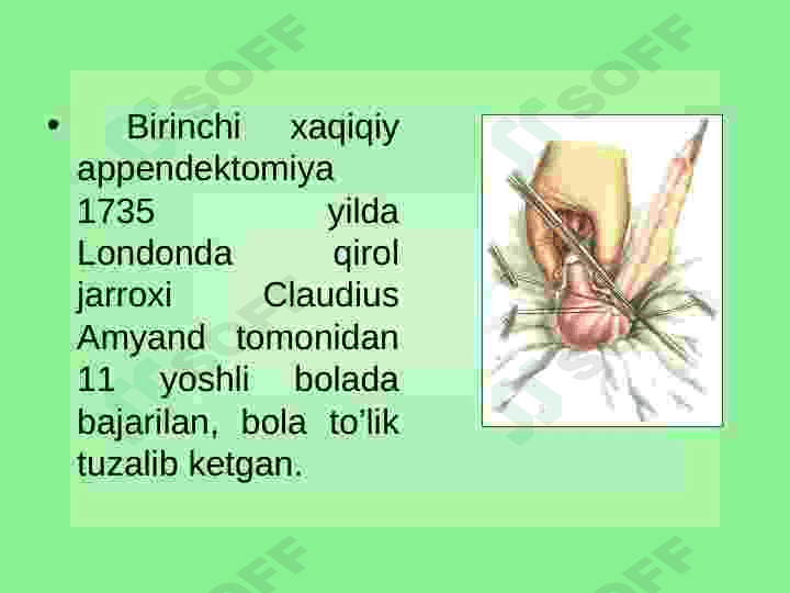 O’tkir appendetsit 3