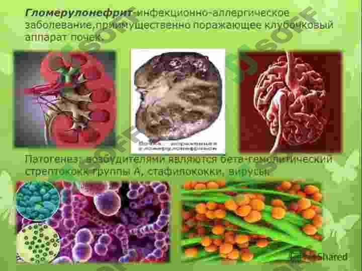 Glomerulonefrit surunkali pielonefrit 3