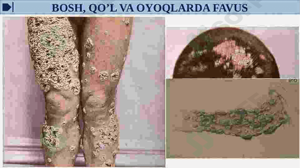 ZAMBURUG’LAR KELTIRIB CHIQARUVCHI KASALLIKLAR(YUZA VA CHUQUR MIKOZ QO’ZG’ATUVCHILARI) LABARATORIYA TASHXISI.PARAZITAR KASALLIKLAR: LESHMANIOZ, MALYARIYA. 5