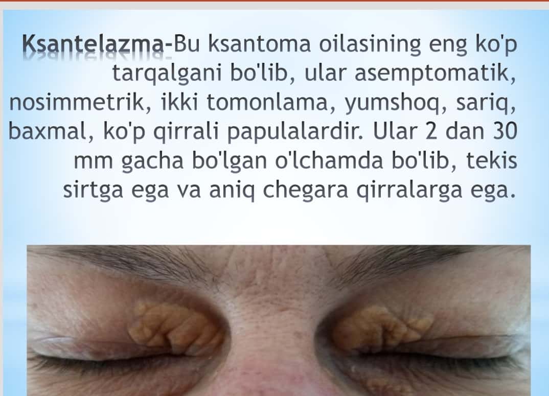 Ksantelazma , lipoma , gigroma 1