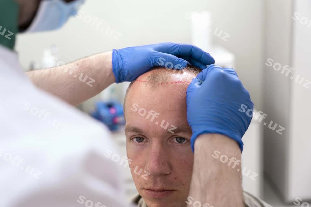 Katta erkak sochlarning ketish muammolari bor | Adult male having balding problems 1