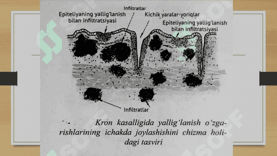 Kron kasalligi 6