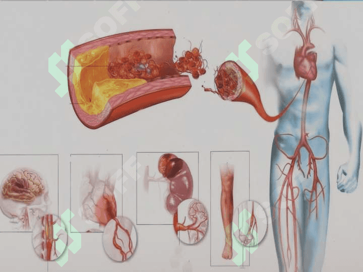 Lerish sindromi ppt 4