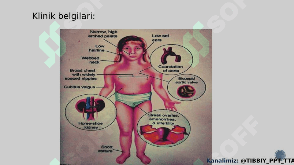 Shevshevskiy terner sindromi ppt 5