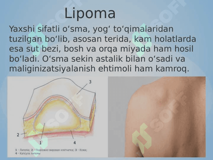 Gidrona va lipoma ppt 7