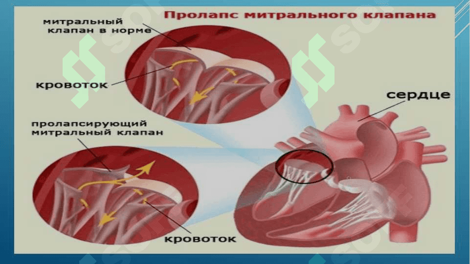 MITRAL KLAPAN PROLAPSI 3