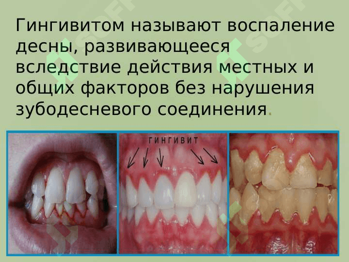 Гингивит диагностика и лечения. 2