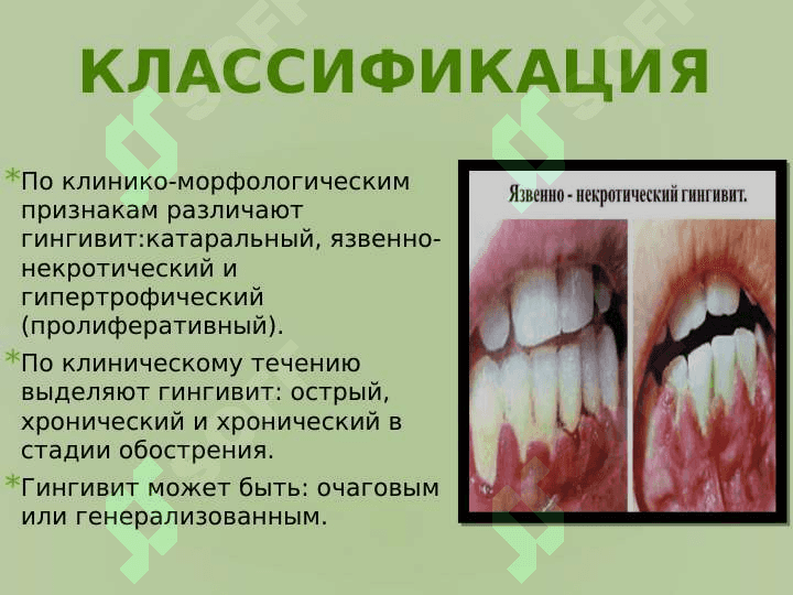 Гингивит диагностика и лечения. 4