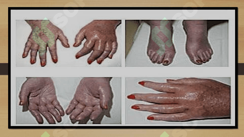 Eritremiya simptomatologiyasi 4