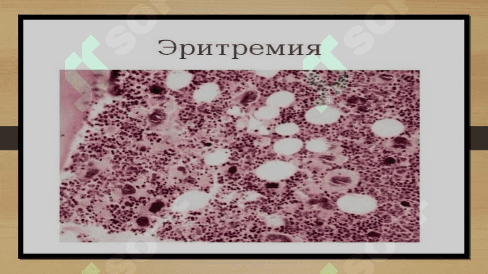 Eritremiya simptomatologiyasi 7