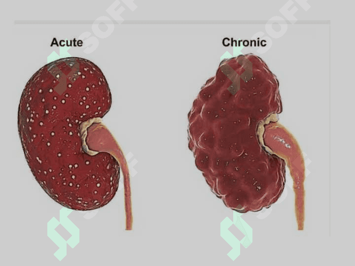 BUYRAK   YALLIG’LANISHI VA IMMUN YALLIG’LANISH  KASALLIKLARINING ETIOLOGIYASI , PATOGENEZI, KASALLIKNING KLINIK NOMOYON BO’LISHI , DIAGNOSTIKASI VA AKTIVLIK MEZONLARI . BUYRAK   YALLIG’LANISHI VA IMMUN YALLIG’LANISH  KASALLIKLARINING ETIOLOGIYASI , PATOGENEZI, KASALLIKNING KLINIK NOMOYON BO’LISHI , DIAGNOSTIKASI VA AKTIVLIK MEZONLARI 2