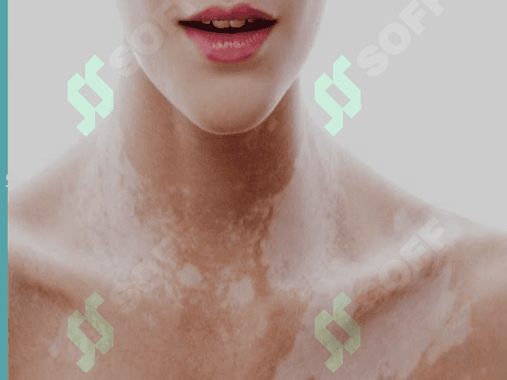 VITILIGO KASALLIGI 2