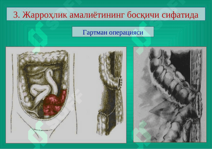 Ichak oqmalari . Ичак оқмалари 6