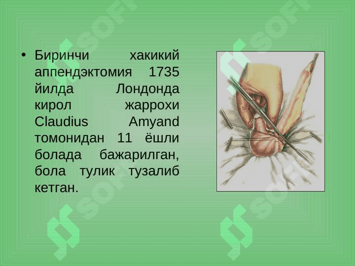 O`tkir appenditsit va uning asoratlari . Ўткир аппендицит ва унинг асоратлари 3
