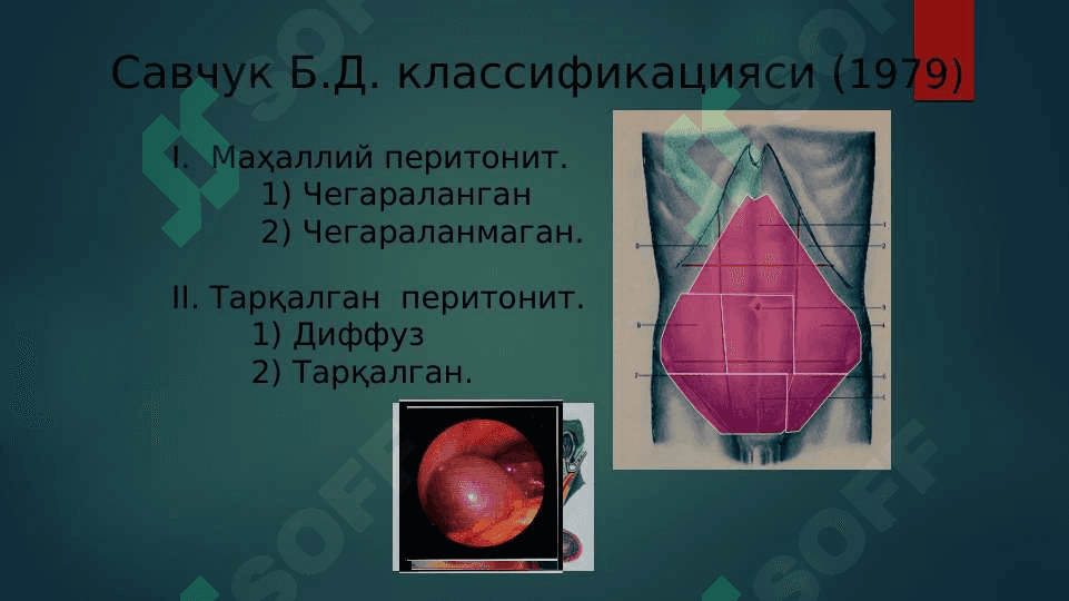 O’tkir peritonit 4