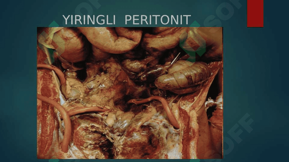 O’tkir peritonit 5