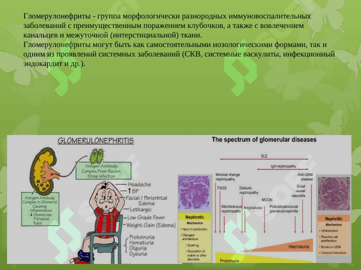 Гломерулонефриты 2
