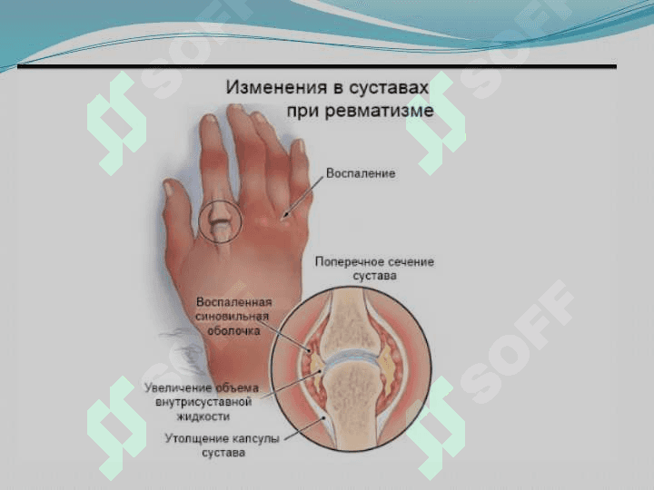 Ревматизм 7