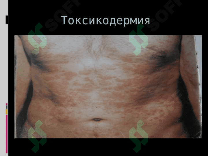 Токсикодермия 7