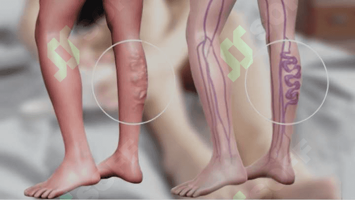Raxit kasalligi va osteoparez 6