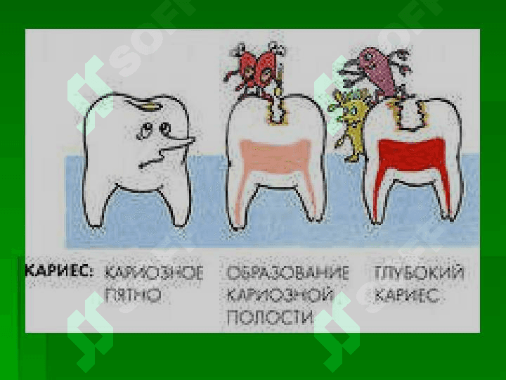 Kariyes , pulpit, periodontit 4