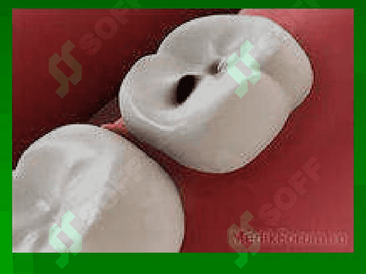 Kariyes , pulpit, periodontit 8