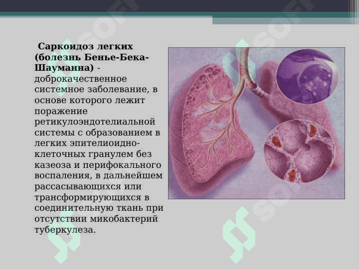 Sarkoidoz . Саркоидоз легких 2