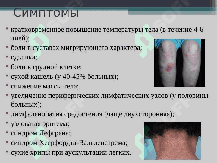 Sarkoidoz . Саркоидоз легких 7