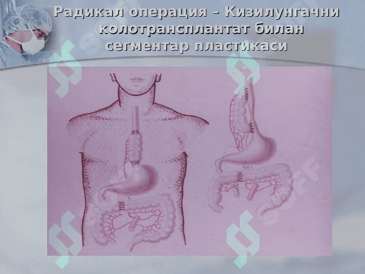 Xirurgik operatsiyalar 8