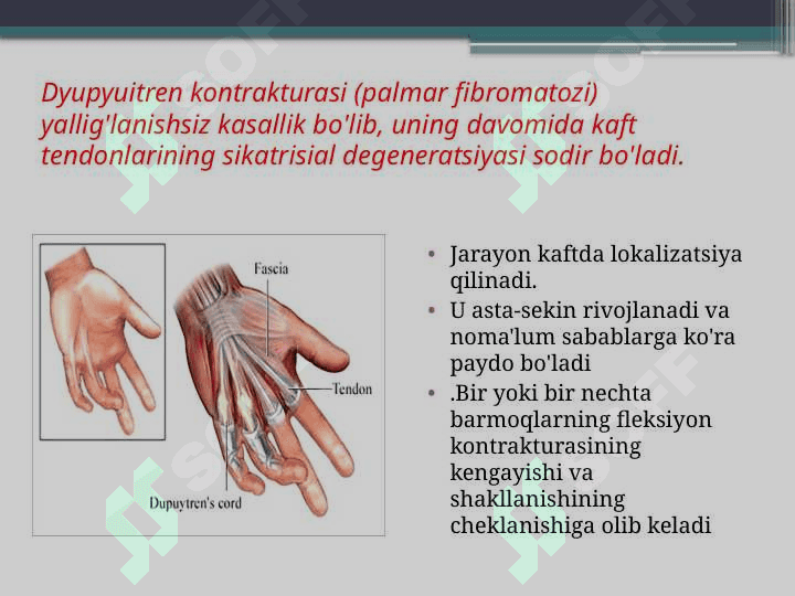Dyupyuitren kontrakturasi 2
