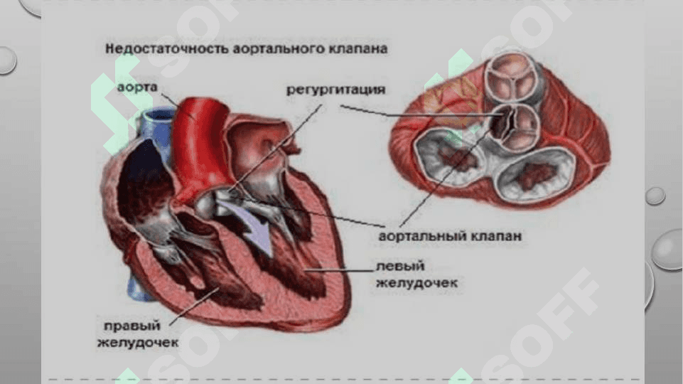 Aortal klapan yetishmovchiligi 3