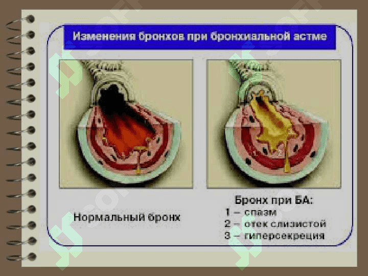 Бронхиал астма.Ўпканинг сурункали обструктив касалликлари. Ўпка ҳавочанлигининг ошиши синдроми. Ўпка эмфиземаси. 4