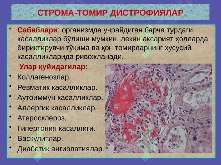 Stroma-tomir distrofiyalar 3