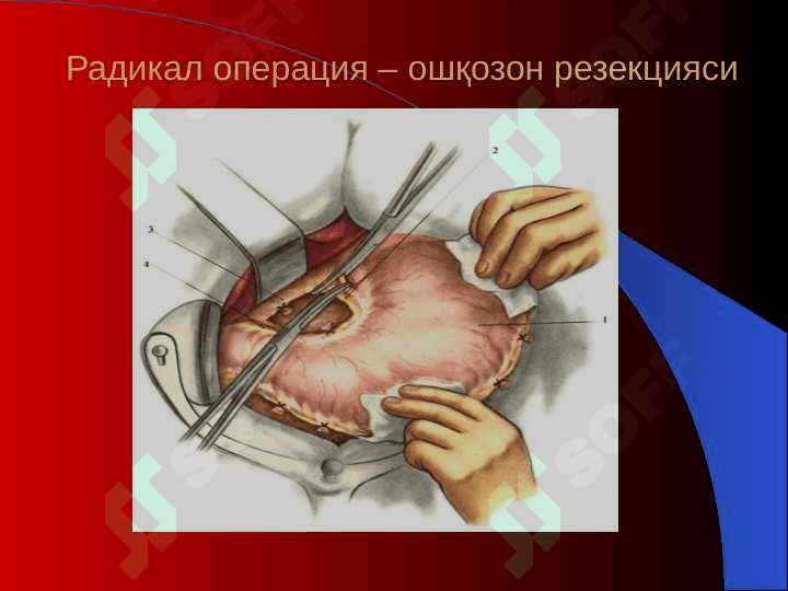Xirurgik operatsiyalar 8