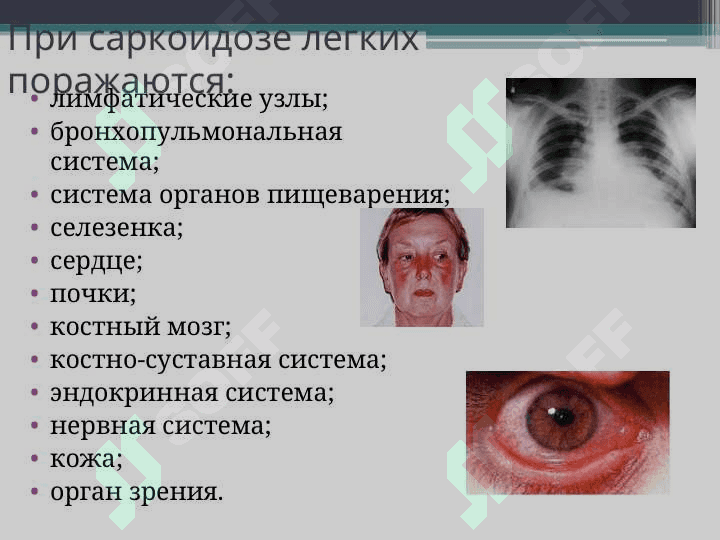 Саркоидоз легких 8