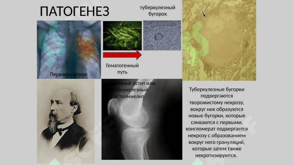 Хирургический туберкулёз. XIRURGIK SIL 3