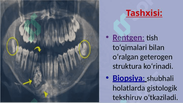 Odontogen o'smalar. Klinikasi, tashxisi, davolash 8