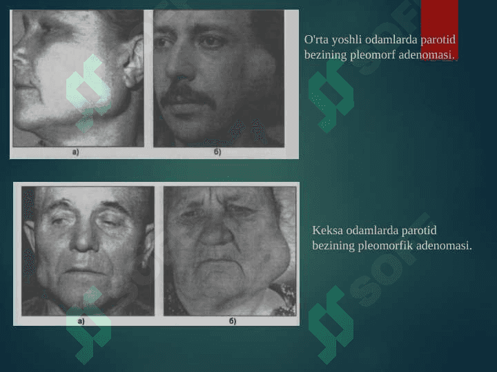 So'lak bezlarining o'smalari 7