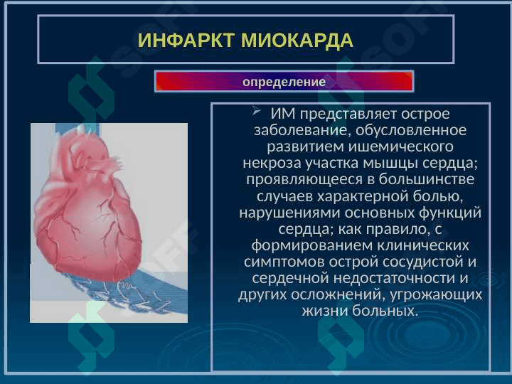 ИНФАРКТ МИОКАРДА 2