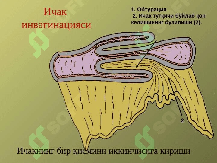 Уткир ичак тутилиши 8