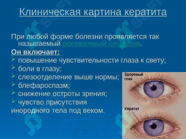 Кератит - воспаление роговицы глаза 5
