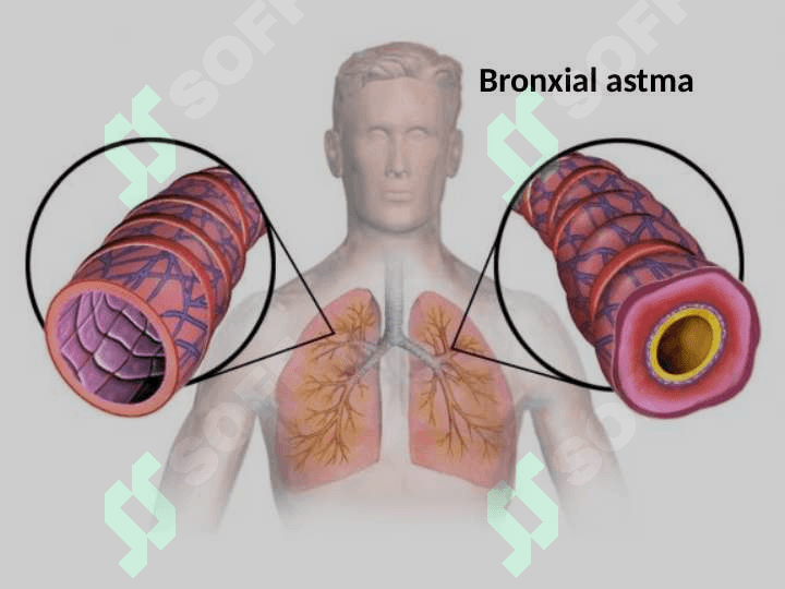 Bronxial astma. O‘pka emfizemasi. 2