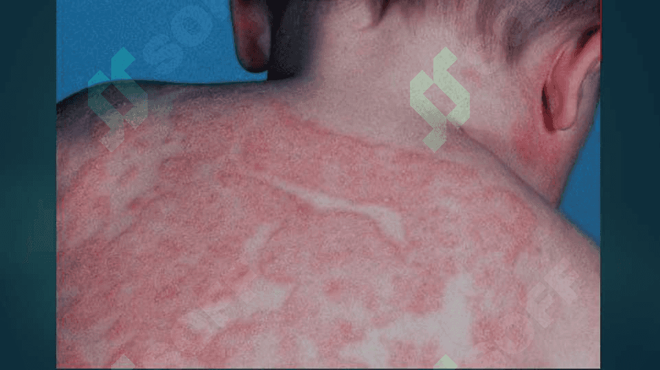 Atopik dermatitlar 3