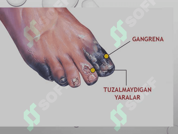 GAZLI GANGRENA

KLINIKA VA DAVOLASH 6