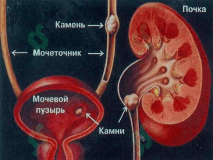 Siydik tosh kasalligi 2