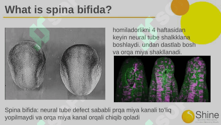 Spina bifida 3