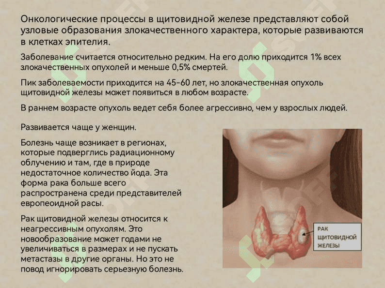 Рак щитовидной железы 2