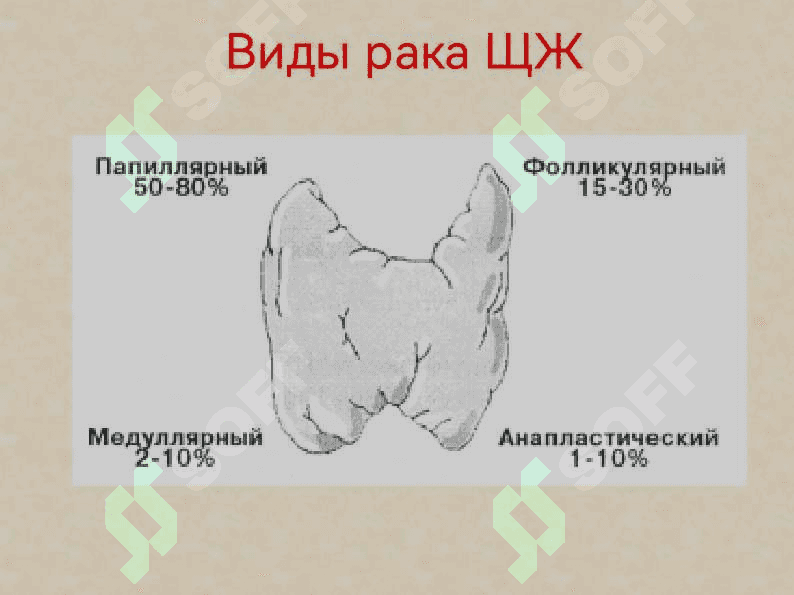 Рак щитовидной железы 5