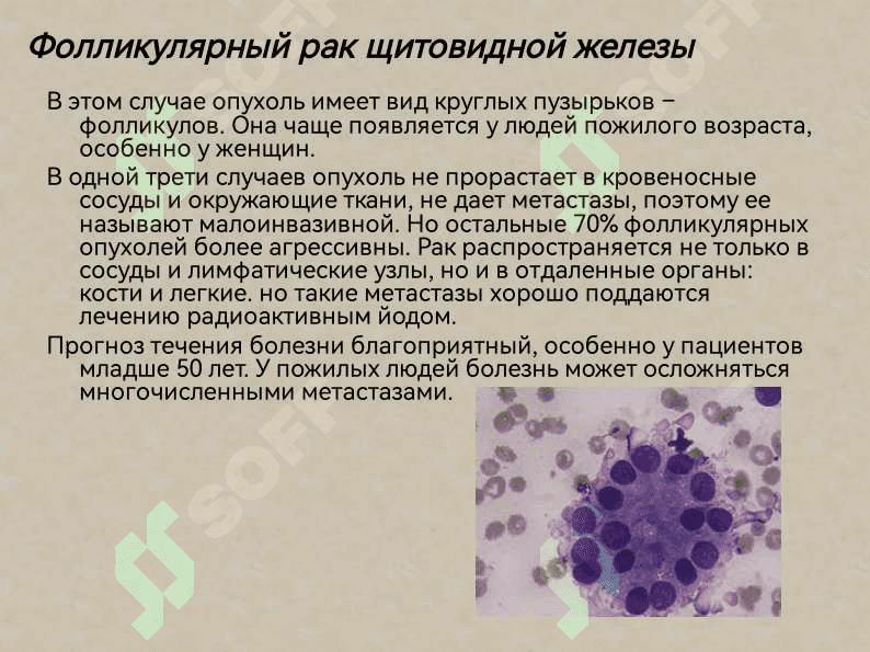 Рак щитовидной железы 7